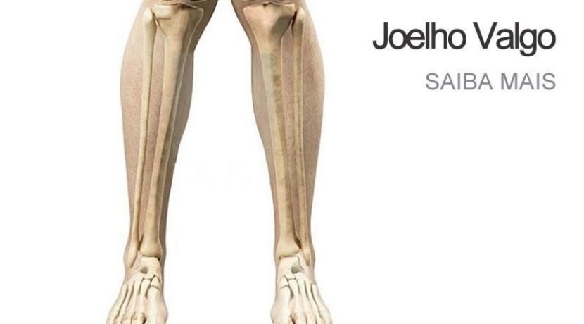 Joelho Valgo