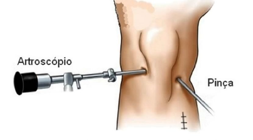 Reconstrução do Ligamento Cruzado Anterior – LCA