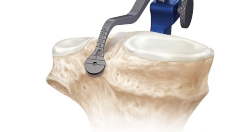Reconstrução do Ligamento Cruzado Posterior – LCP