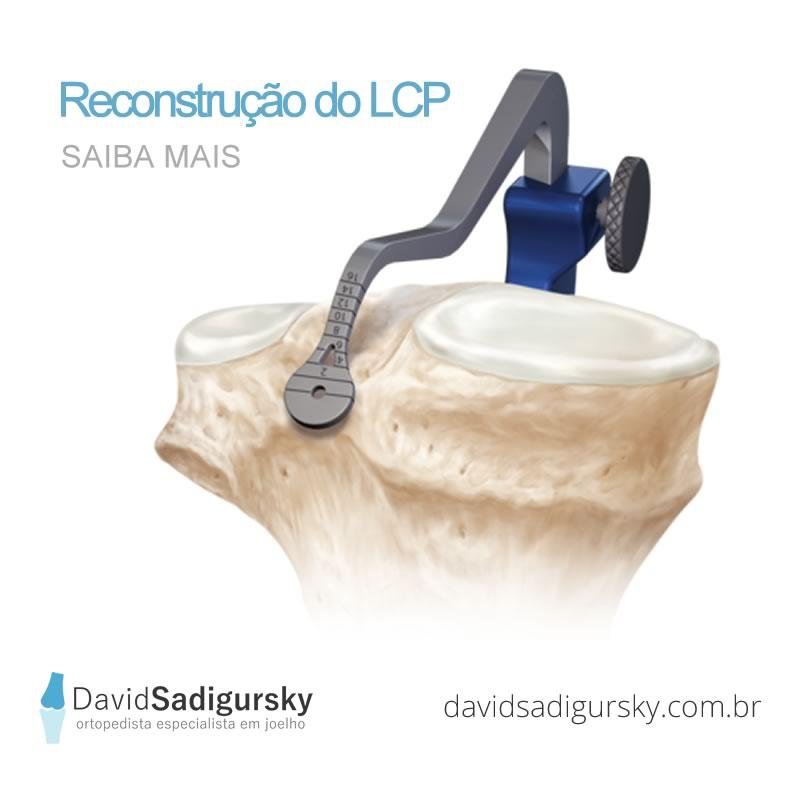 Reconstrução do Ligamento Cruzado Posterior – LCP