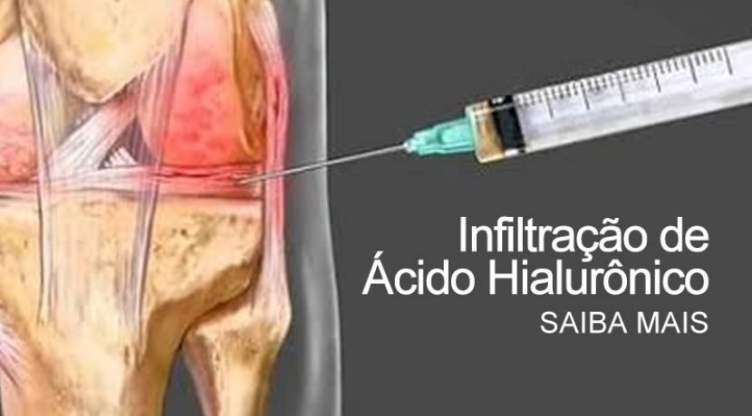 Infiltração de Ácido Hialurônico